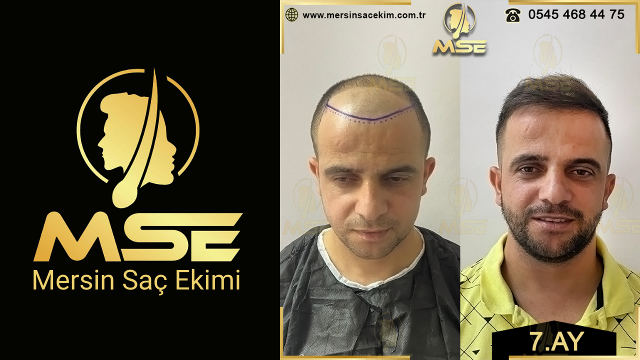 Mersin Saç Ekimi